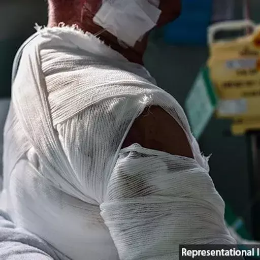 தரவு, படுக்கைகள், பயிற்சி பெற்ற மருத்துவர்களின் பற்றாக்குறையால் பாதிக்கப்படும் இந்தியாவின் தீக்காய மேலாண்மை தரவு, படுக்கைகள், பயிற்சி பெற்ற மருத்துவர்களின் பற்றாக்குறையால் பாதிக்கப்படும் இந்தியாவின் தீக்காய மேலாண்மை