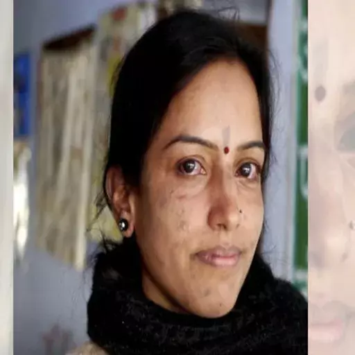 கண்டறியப்படும் நோயாளிகள், இந்தியாவில் மீண்டும் தொழுநோய்?  வல்லுனர்கள் சந்தேகம்;  மாறுபடுகிறது அரசு